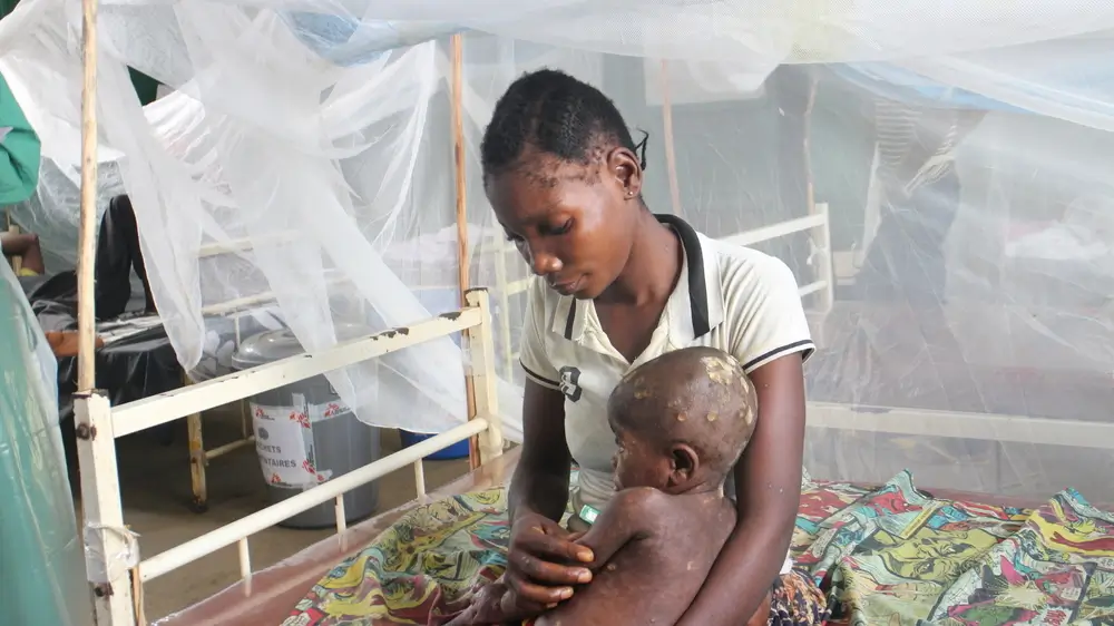 Un niño de 1 año que padece viruela símica, Mpox, en los brazos de su madre. Está hospitalizado en el hospital general de referencia de Bolomba, República Democrática del Congo.