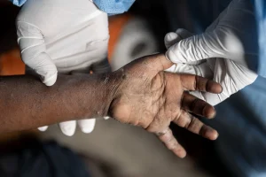 Un primer plano de la mano de un paciente durante una consulta de detección de Mpox.