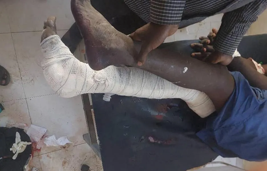 Un paciente del Hospital Universitario Nyala, que apoyamos, tras los ataques aéreos del 3 de febrero de 2025. Sudán