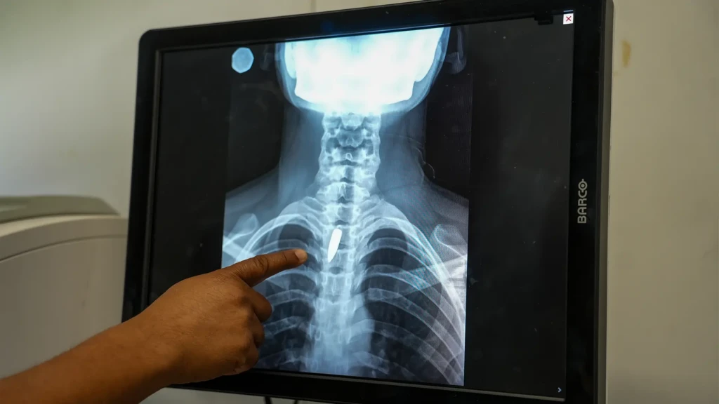 Una radiografía muestra una bala alojada en el pecho de Linda. Los cirujanos determinaron que era demasiado arriesgado extraerla, por lo que tendrá que seguir viviendo con ella. Linda fue alcanzada mientras estaba en la iglesia, cuando un grupo armado abrió fuego contra un helicóptero que se cree está vinculado a la policía. Puerto Príncipe, Haití, enero de 2026.