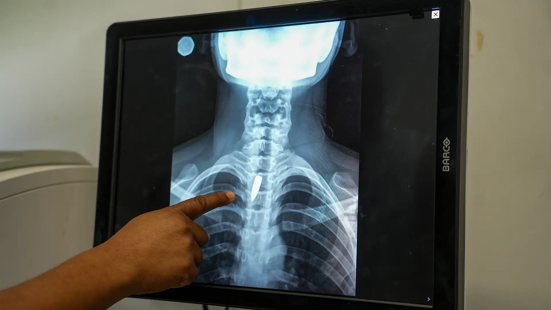 Una radiografía muestra una bala alojada en el pecho de Linda. Los cirujanos determinaron que era demasiado arriesgado extraerla, por lo que tendrá que seguir viviendo con ella. Linda fue alcanzada mientras estaba en la iglesia, cuando un grupo armado abrió fuego contra un helicóptero que se cree está vinculado a la policía. Puerto Príncipe, Haití, enero de 2026.