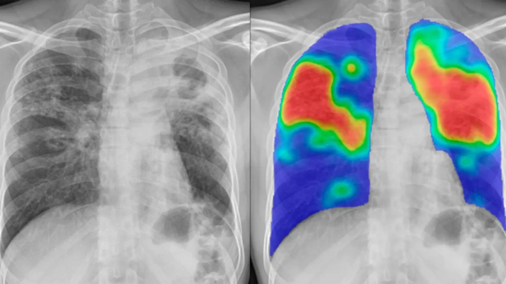 La radiografía de tórax muestra una puntuación CAD4TB muy alta (94). Las zonas rojas/naranjas indican las regiones que la IA considera afectadas por la tuberculosis.