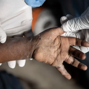 Un primer plano de la mano de un paciente durante una consulta de detección de Mpox.