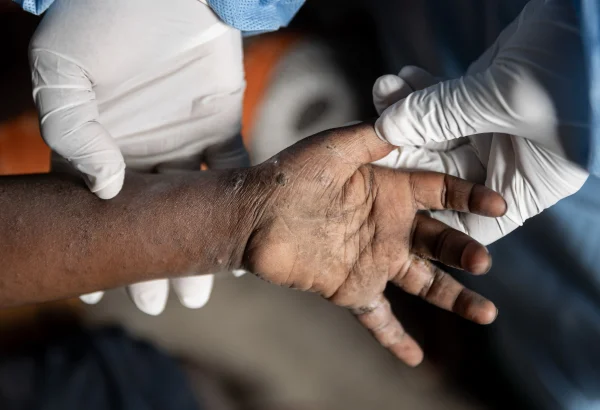 Un primer plano de la mano de un paciente durante una consulta de detección de Mpox.