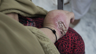 Mrs Iqbal Story - Cutaneous Leishmaniasis Treatment, Peshawar
